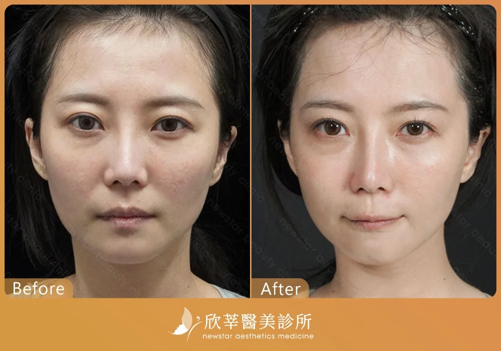 臉部拉提_拉提案例分享