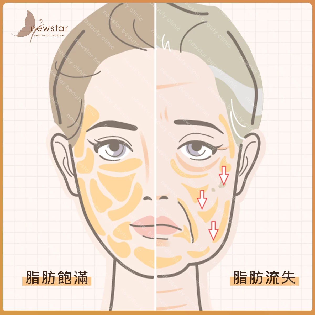臉部拉提_臉部老化_脂肪