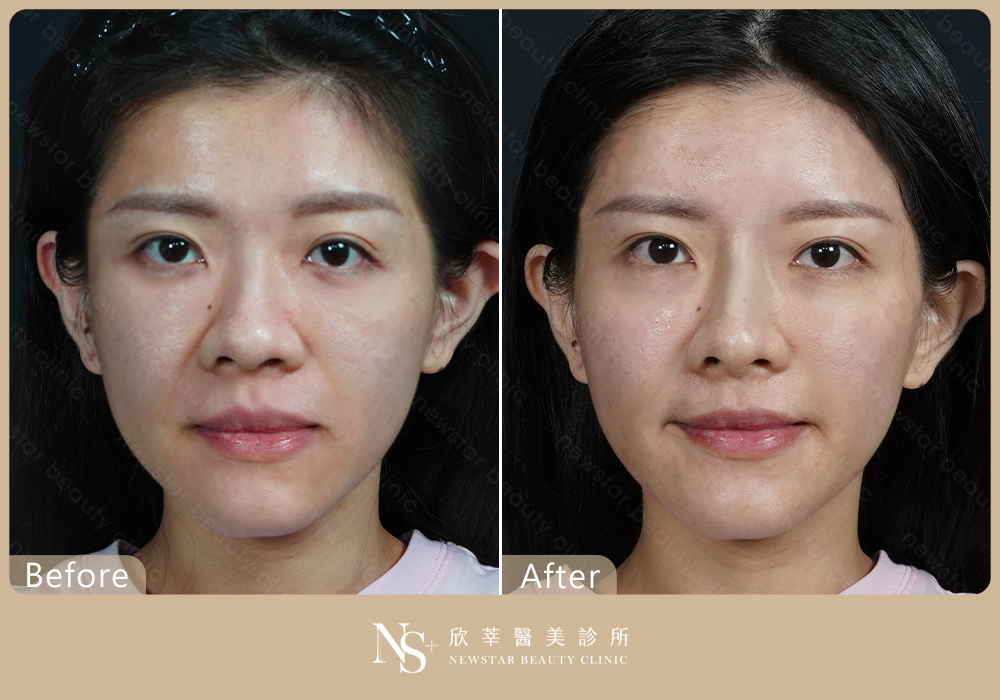 玻尿酸拉提BA_長板01