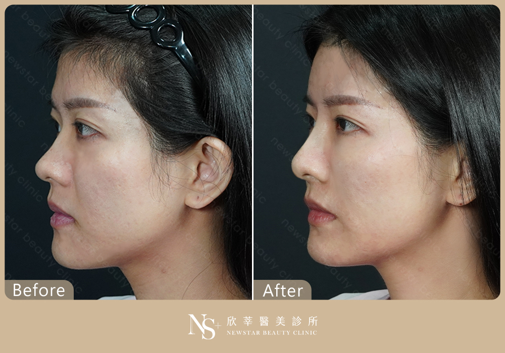 玻尿酸拉提BA_長板02