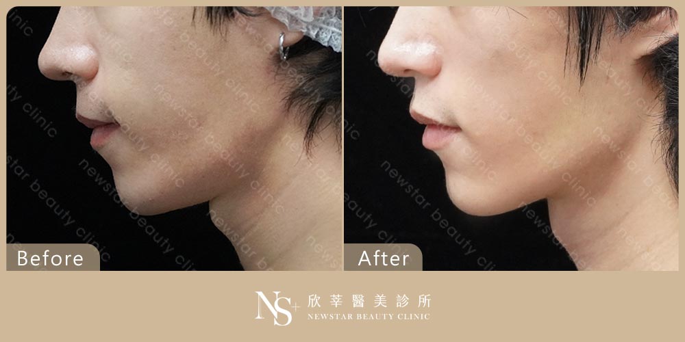 肉毒BA_下顎咀嚼肌01