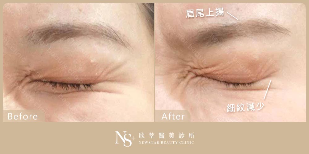 肉毒BA_眼周皺紋01