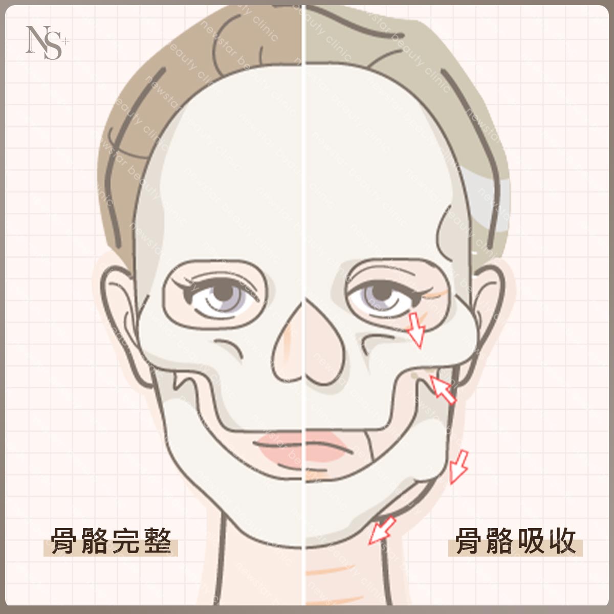 臉部老化_骨骼肌肉凹陷