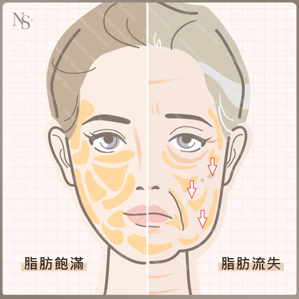 臉部老化_脂肪流失