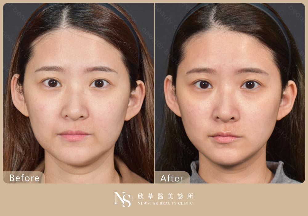 電波拉提BA_中下臉拉提01