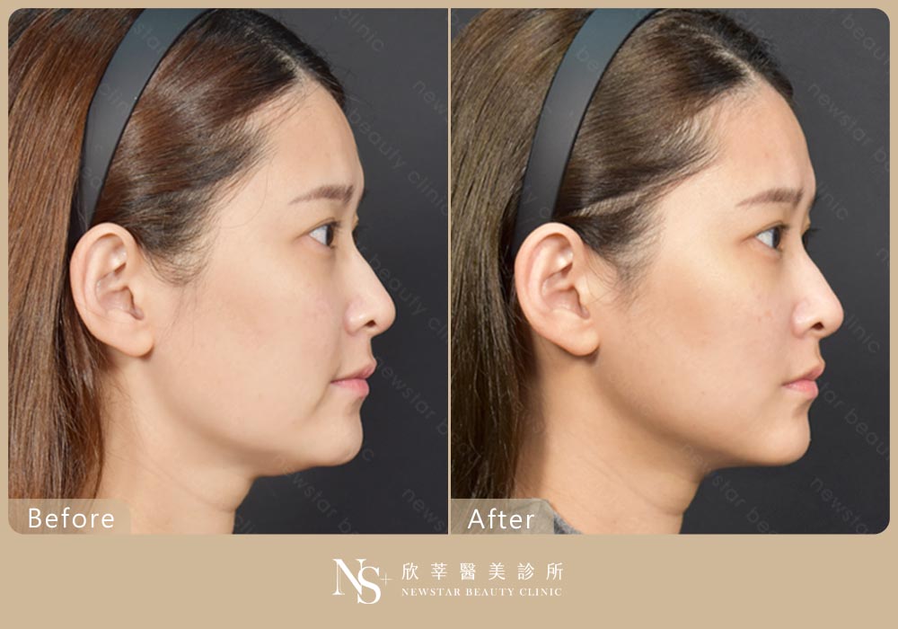 電波拉提BA_中下臉拉提02