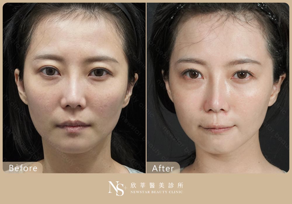 音波拉提BA_長板01