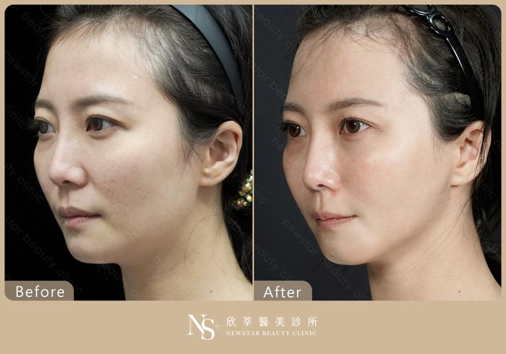 音波拉提BA_長板02