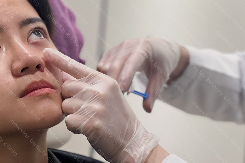 膠原蛋白熊貓針qa_示意圖01