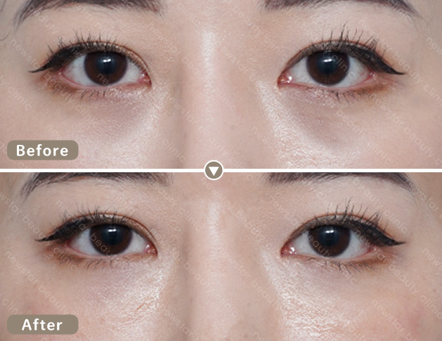 膠原蛋白熊貓針案例_01