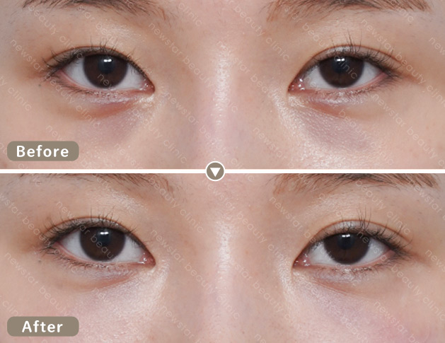 膠原蛋白熊貓針案例_03