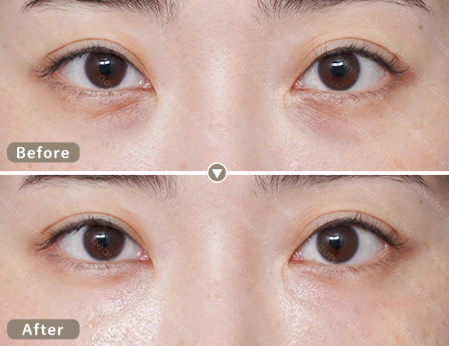 膠原蛋白熊貓針案例_04