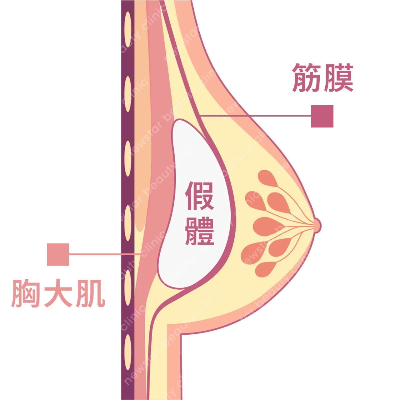 隆乳費用_假體位置_筋膜