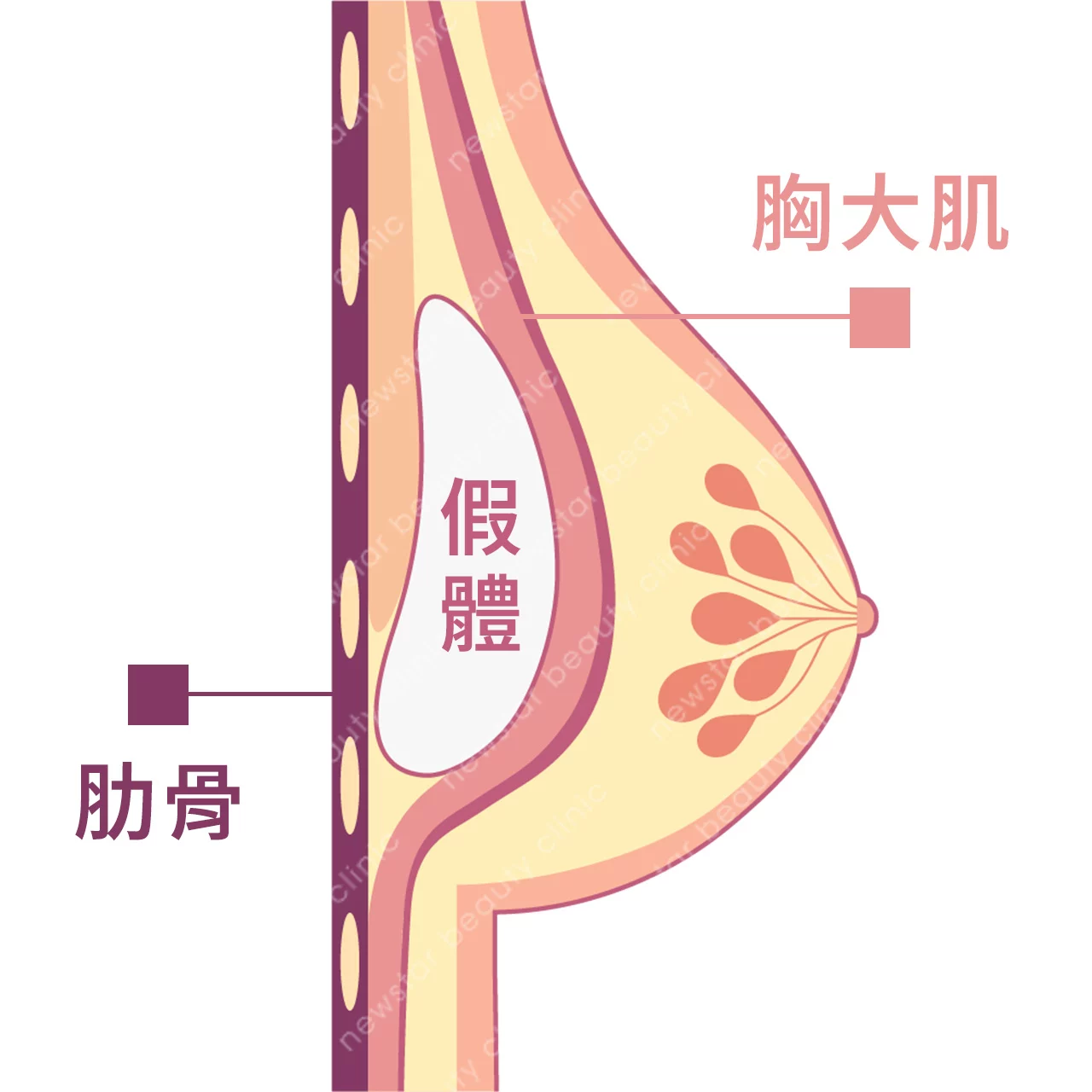 隆乳費用_假體位置_胸大肌