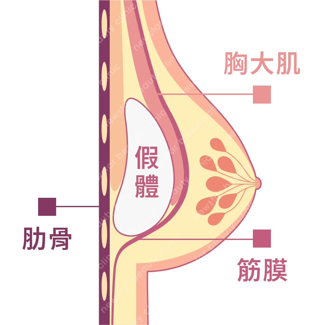 隆乳費用_假體位置_雙平面