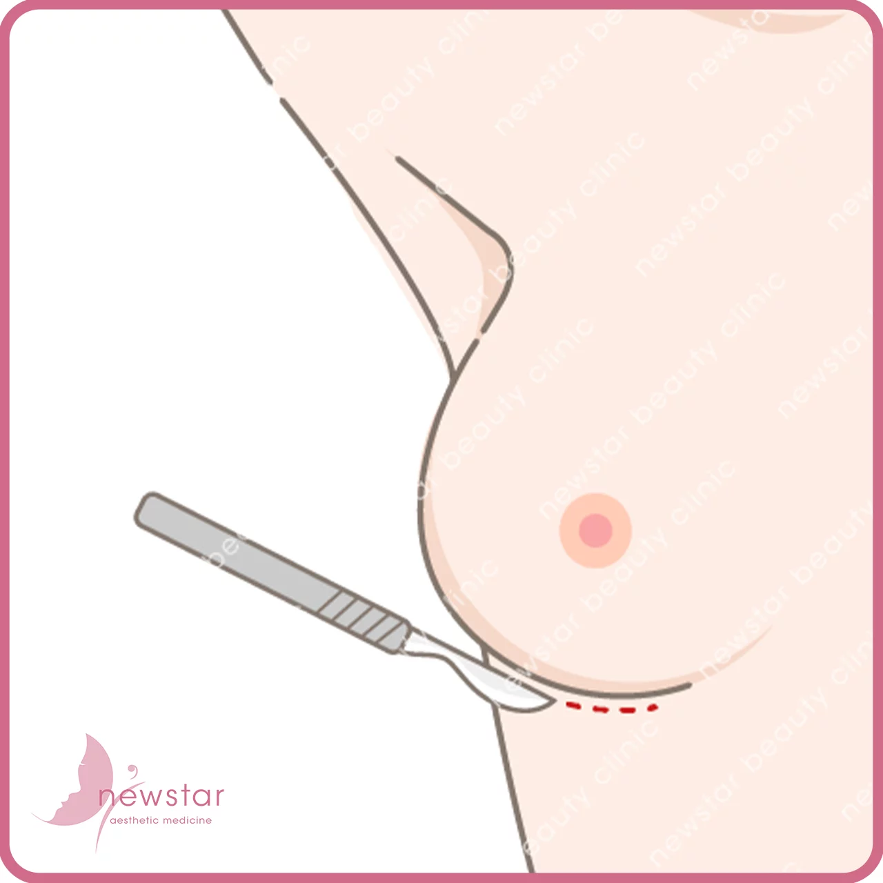 隆乳費用_手術切口_乳下緣