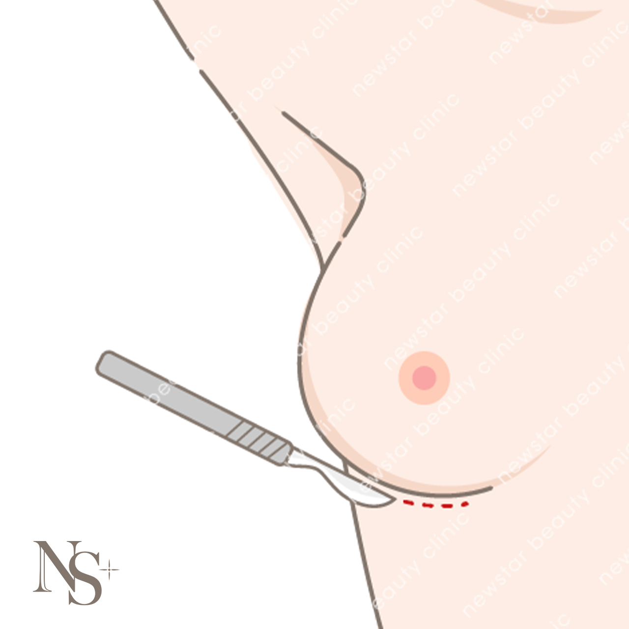 隆乳費用_手術切口_乳下緣