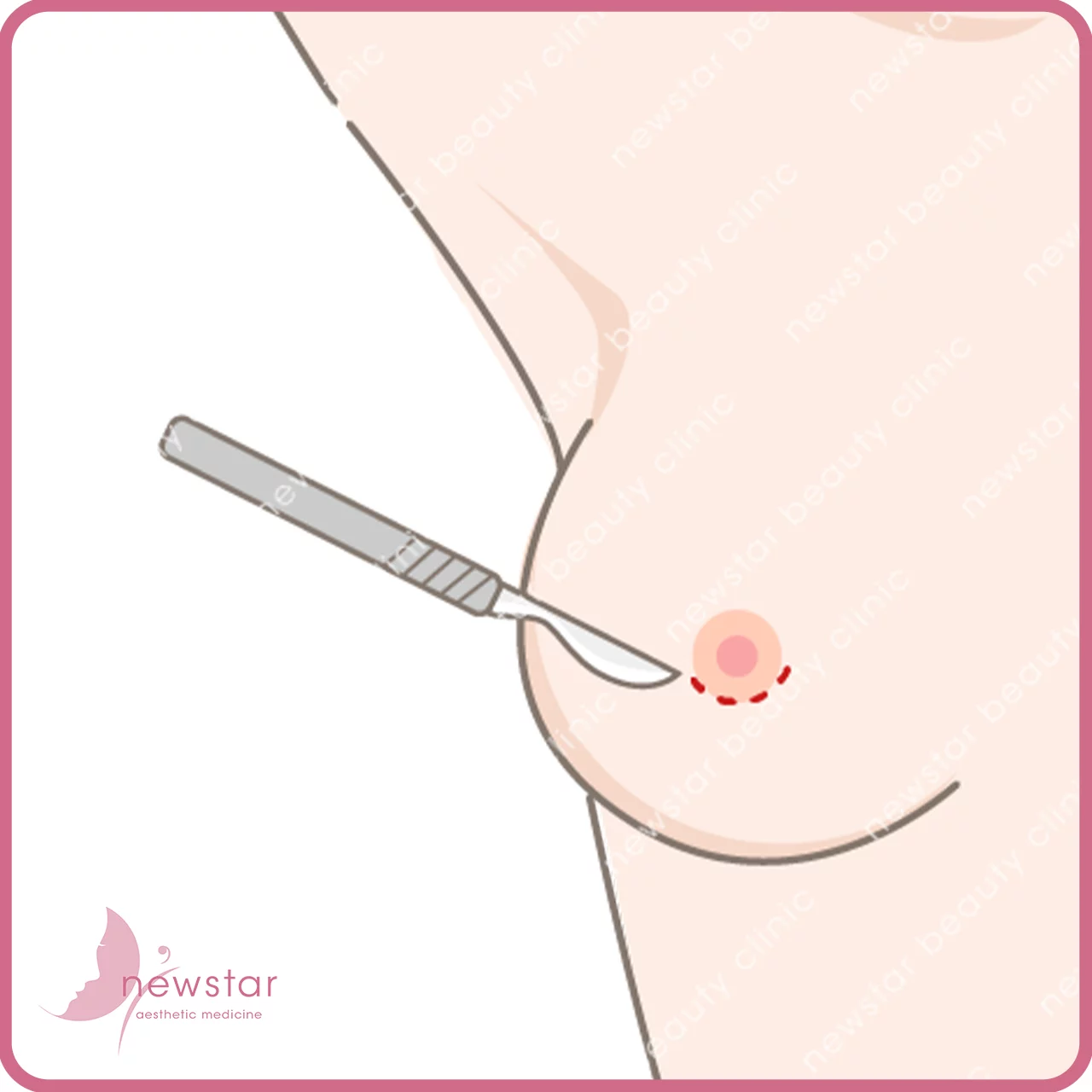 隆乳費用_手術切口_乳暈