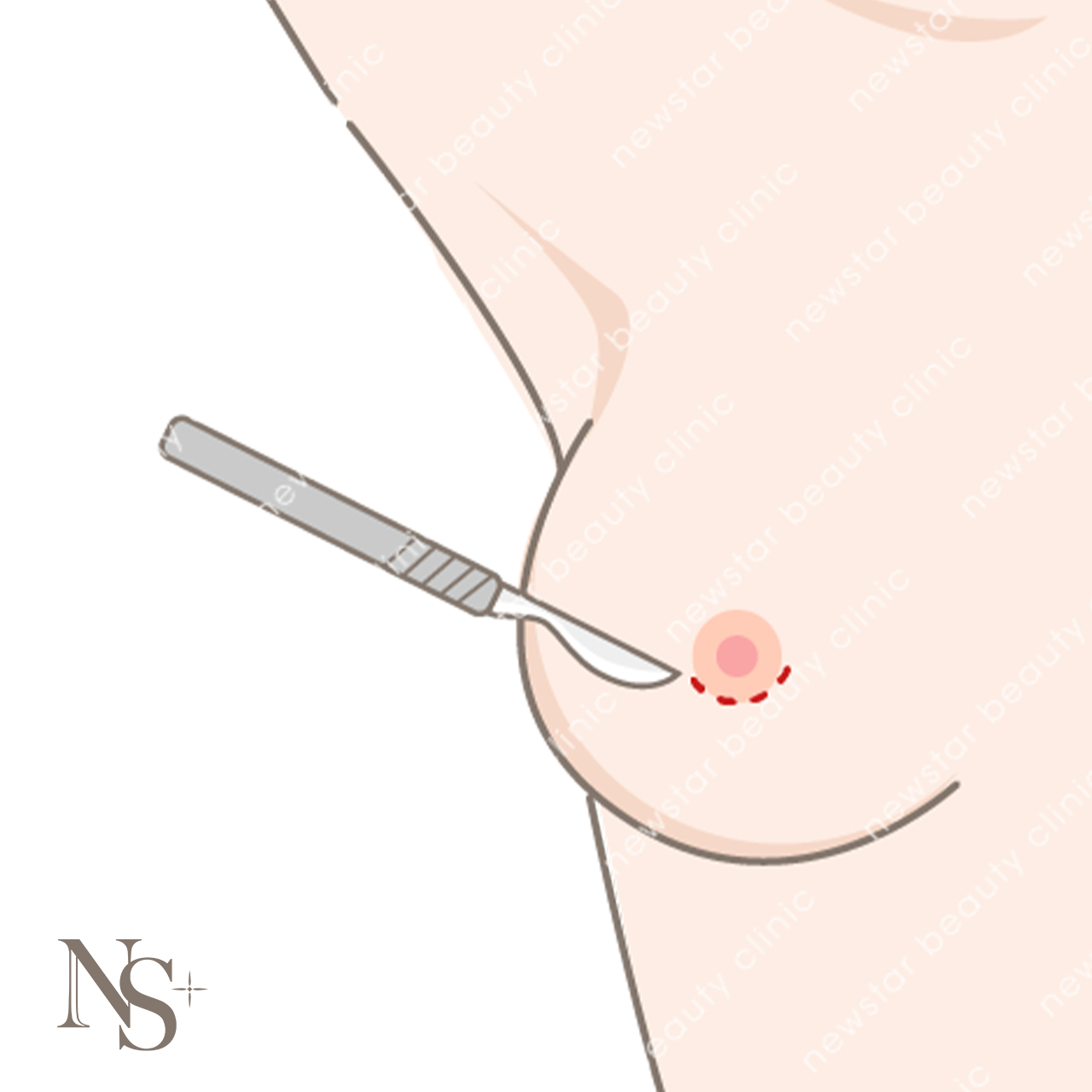 隆乳費用_手術切口_乳暈