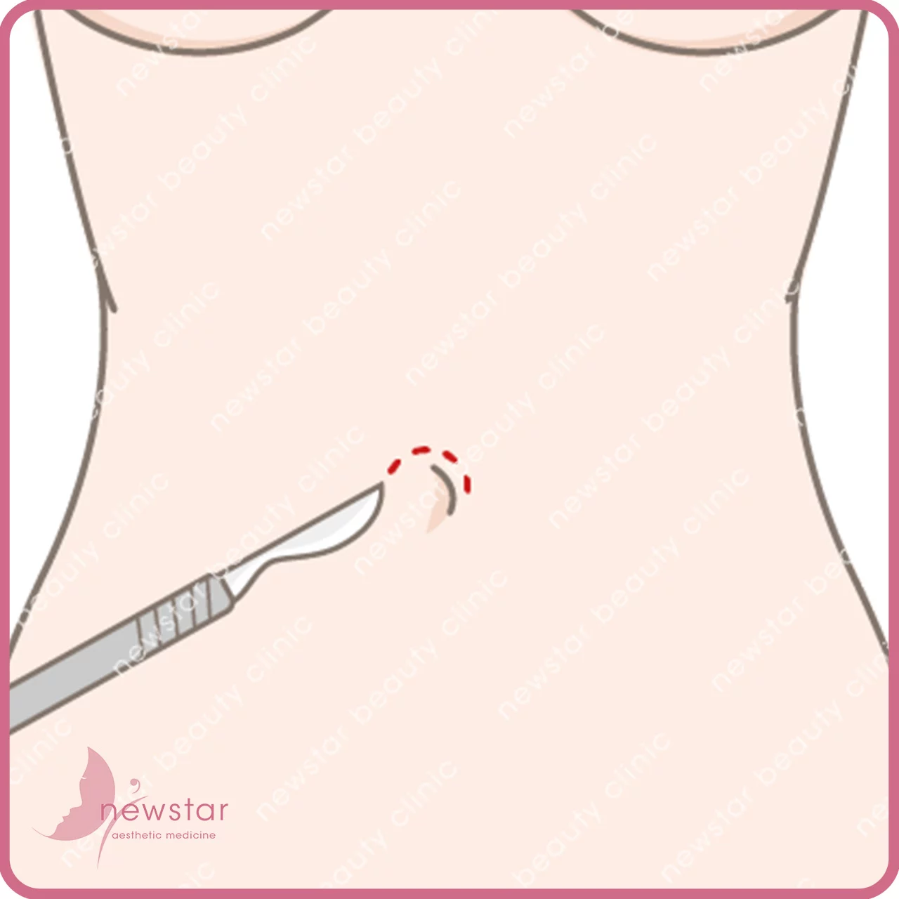 隆乳費用_手術切口_肚臍