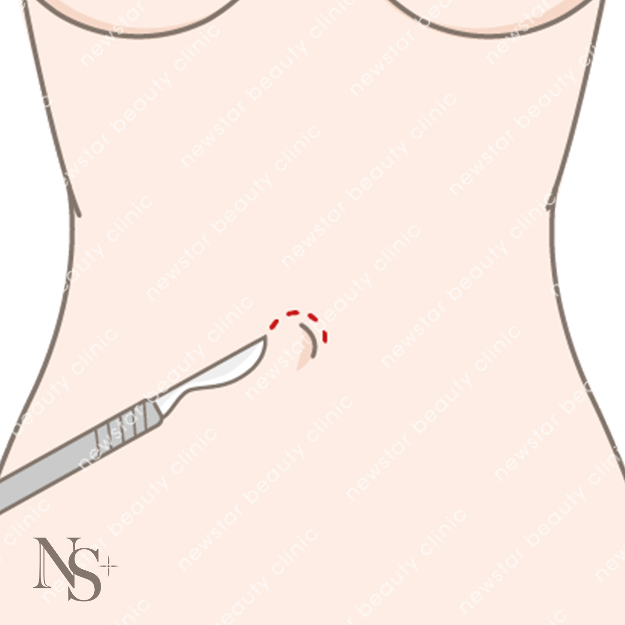 隆乳費用_手術切口_肚臍