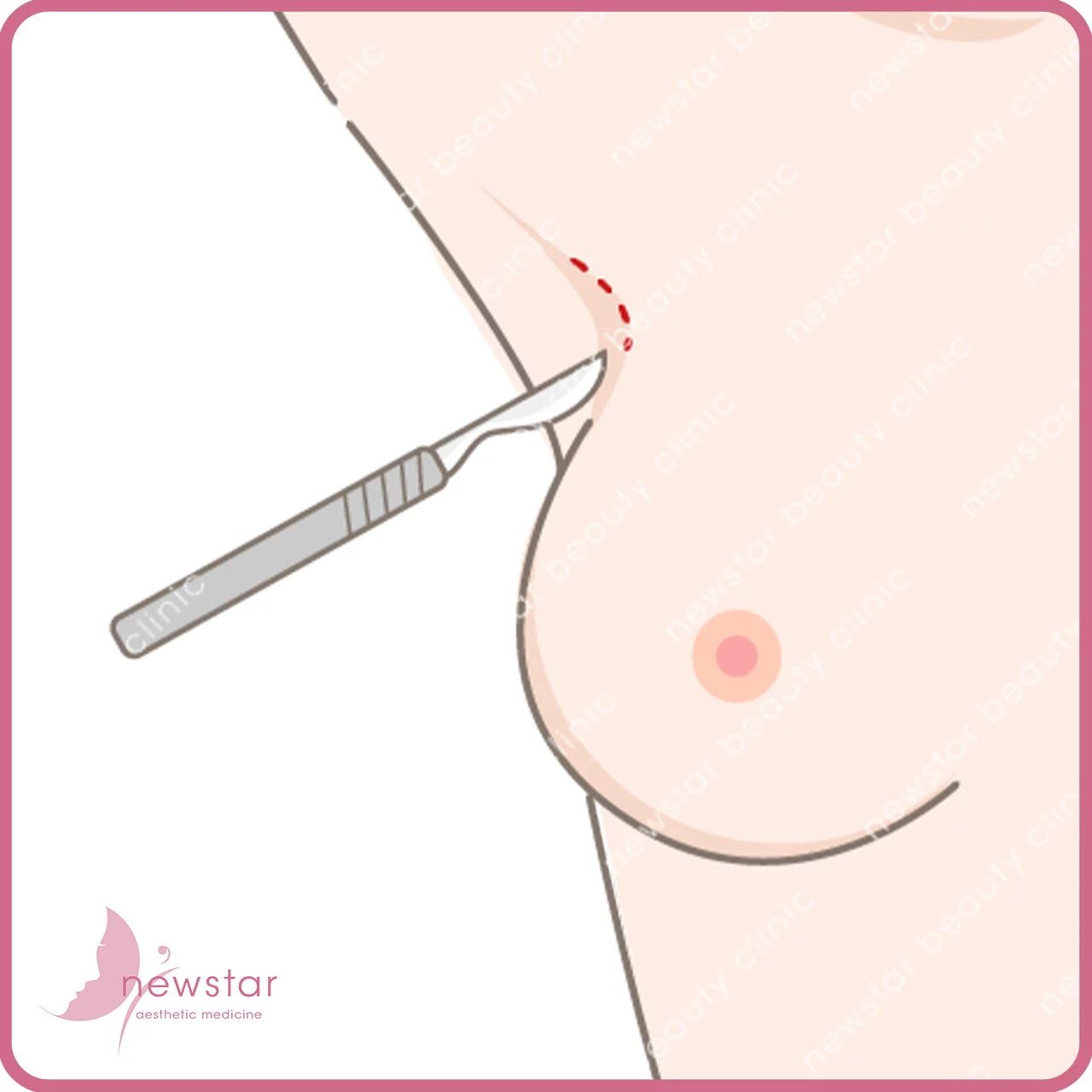隆乳費用_手術切口_腋下