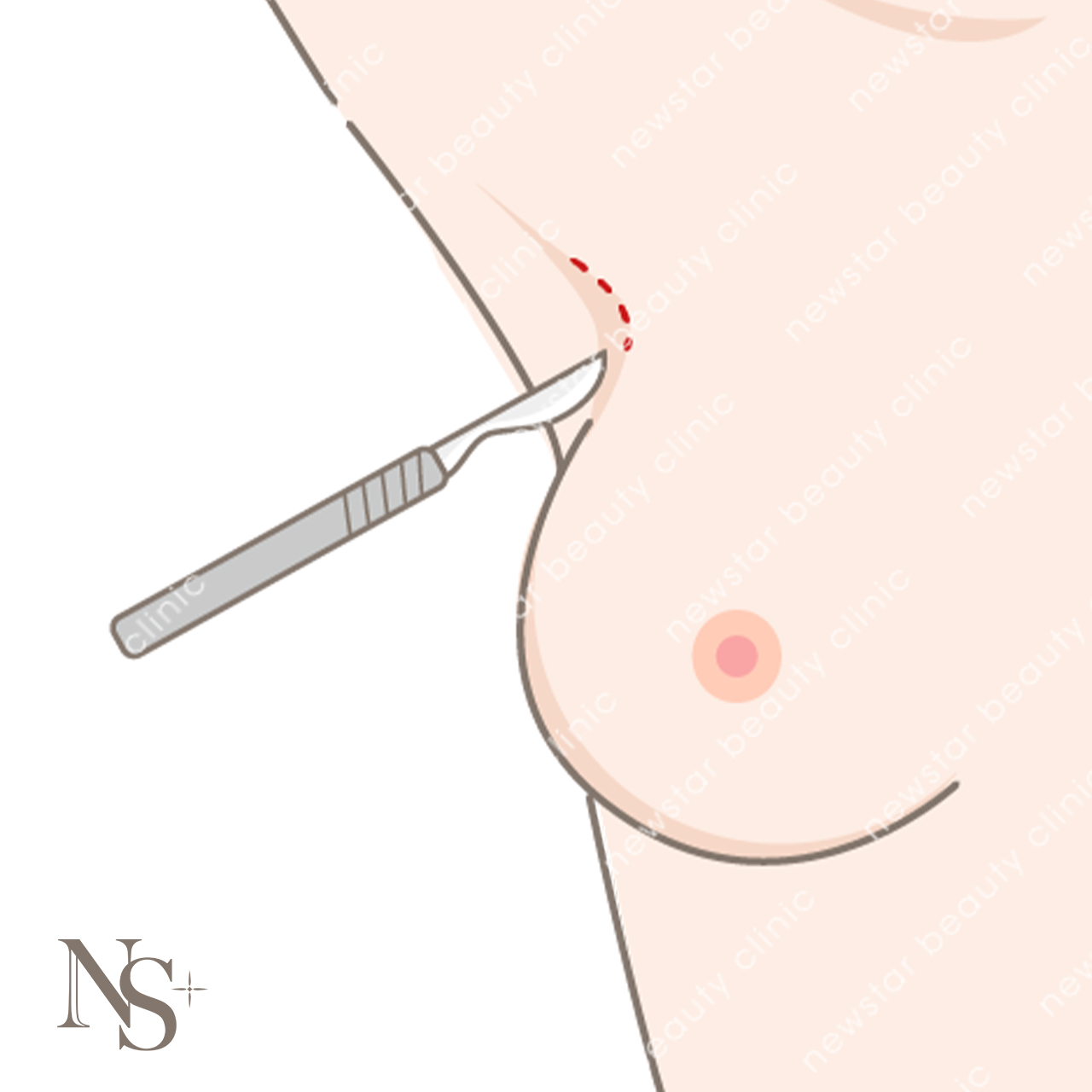 隆乳費用_手術切口_腋下