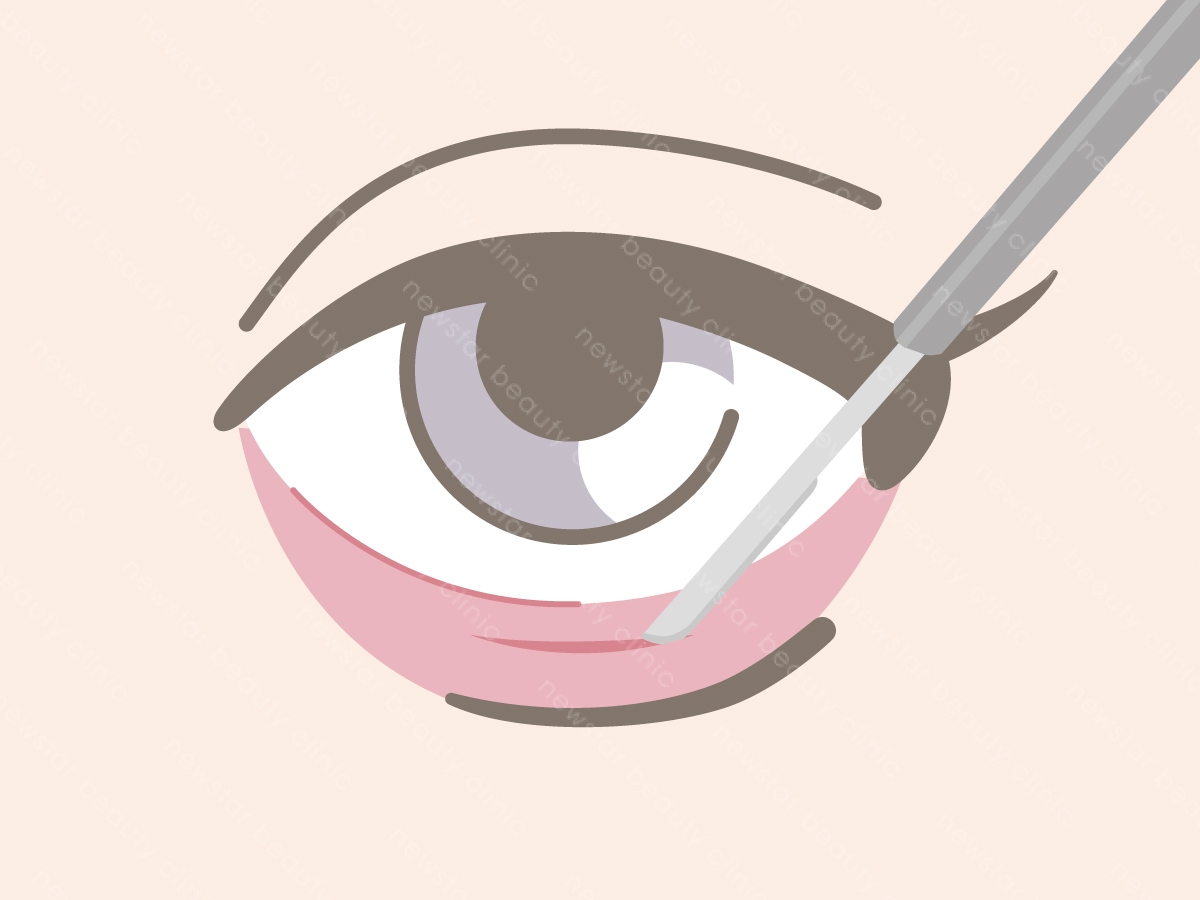 眼袋手術_內開