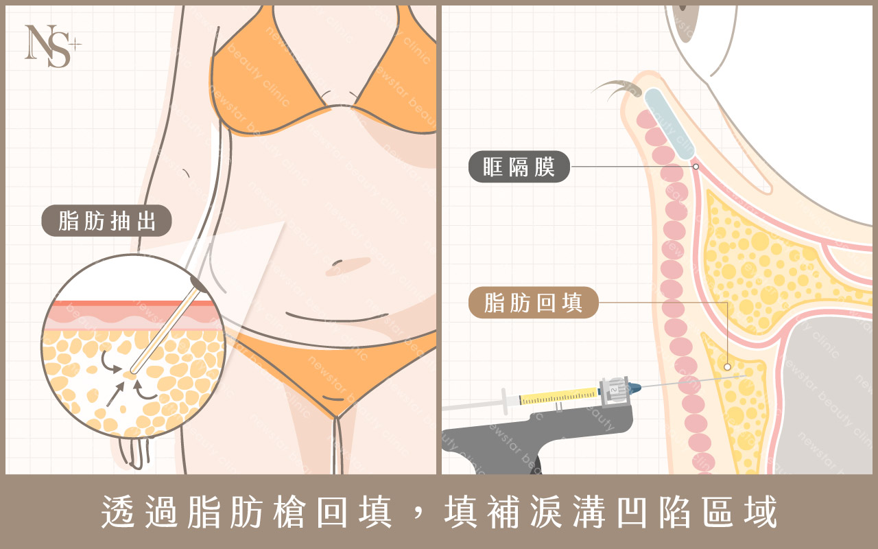 眼袋回填手術示意圖