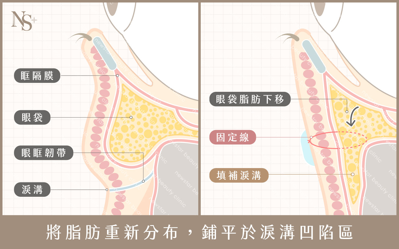 眼袋轉位手術示意圖