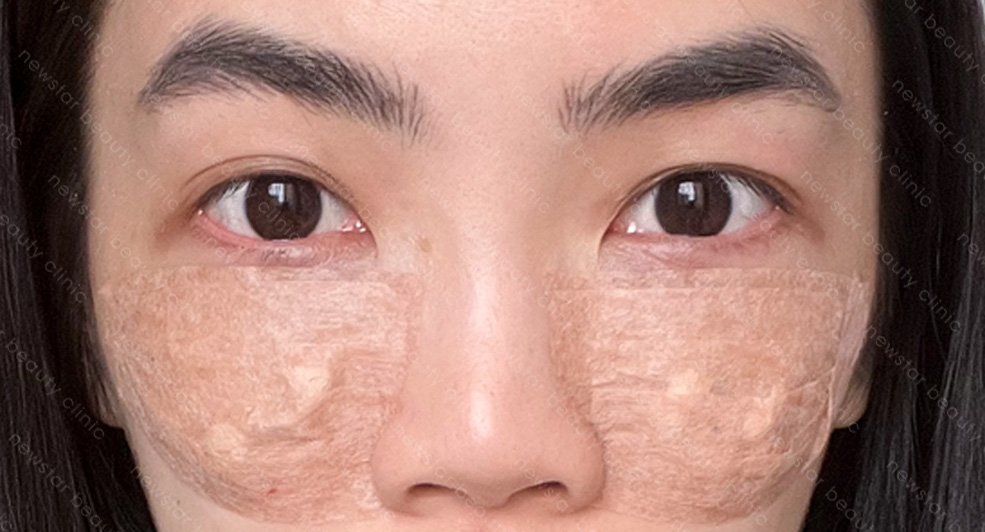 眼袋手術_術後恢復_當天