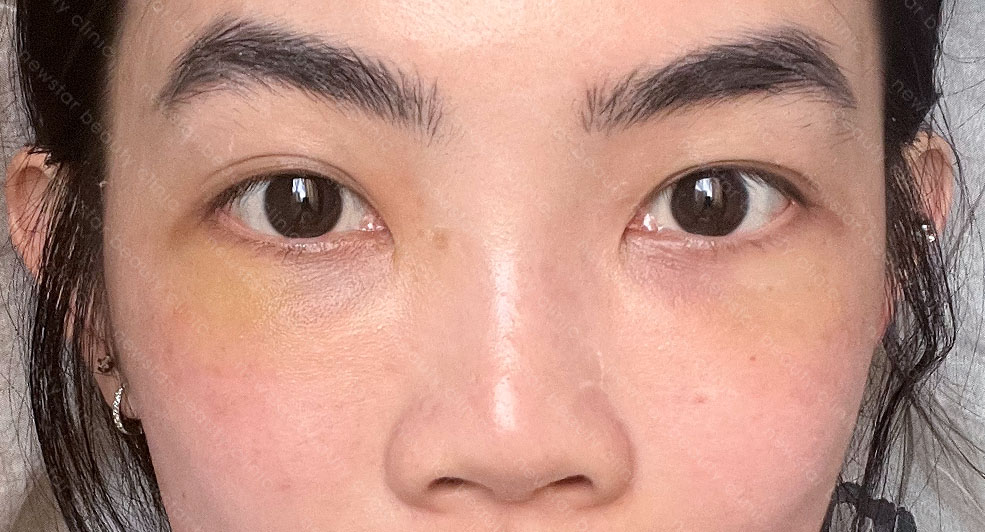 眼袋手術_術後恢復_術後10天