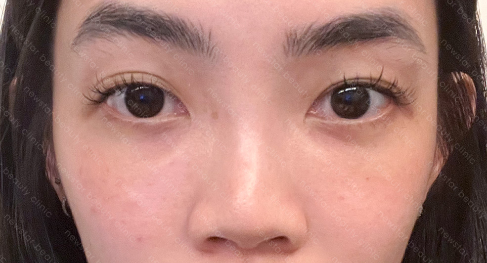 眼袋手術_術後恢復_術後15天