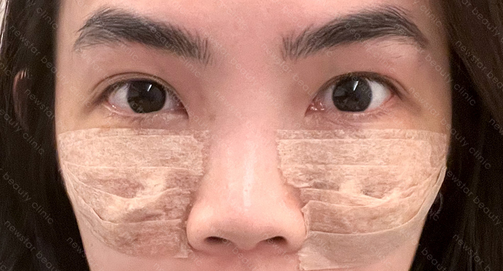 眼袋手術_術後恢復_術後5天