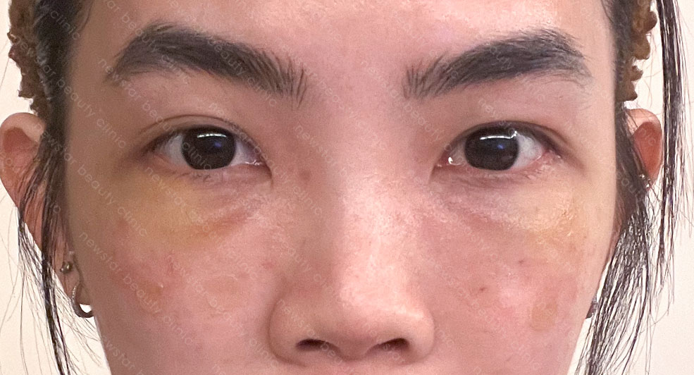 眼袋手術_術後恢復_術後7天