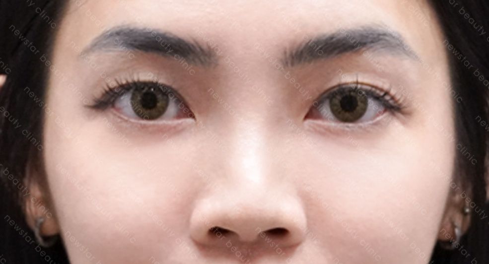 眼袋手術_術後恢復_術後一個月