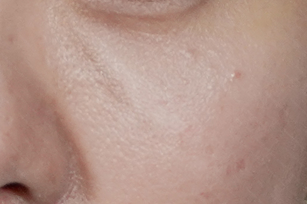 眼袋手術可能有的副作用/後遺症_出現淚溝或凹陷