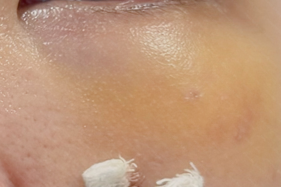 眼袋手術可能有的副作用/後遺症_瘀青腫脹