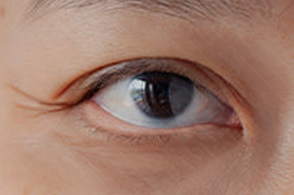 眼袋手術可能有的副作用/後遺症_眼瞼外翻