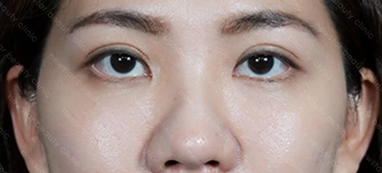 眼袋內開+脂肪轉位+補蘋果肌_04術前