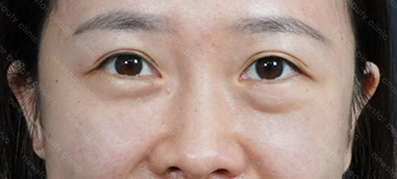 眼袋內開+脂肪轉位+補蘋果肌_03術前