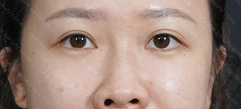 眼袋內開+脂肪轉位+補蘋果肌_03術後