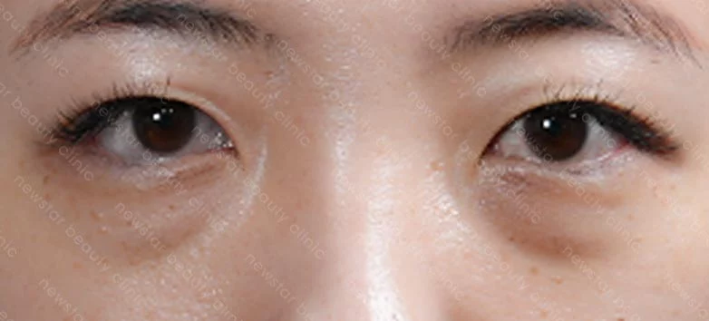 眼袋內開+脂肪轉位_05術前