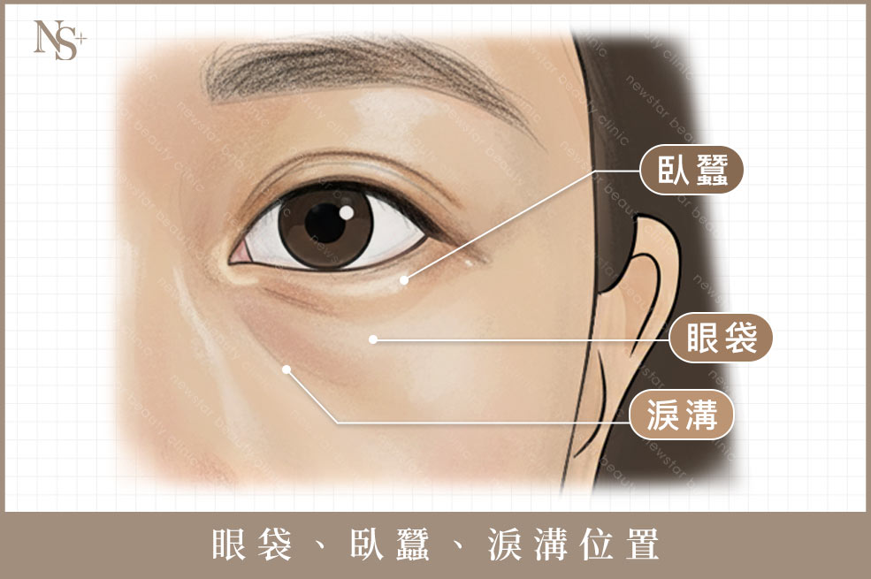 眼袋(正面)淚溝眼袋臥蠶位置02