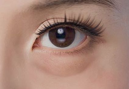 眼袋種類－假性眼袋