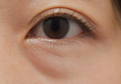 眼袋種類－先天型眼袋