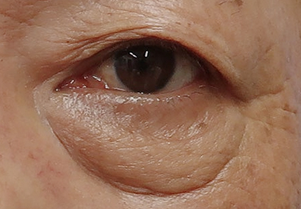 眼袋種類 鬆弛型眼袋