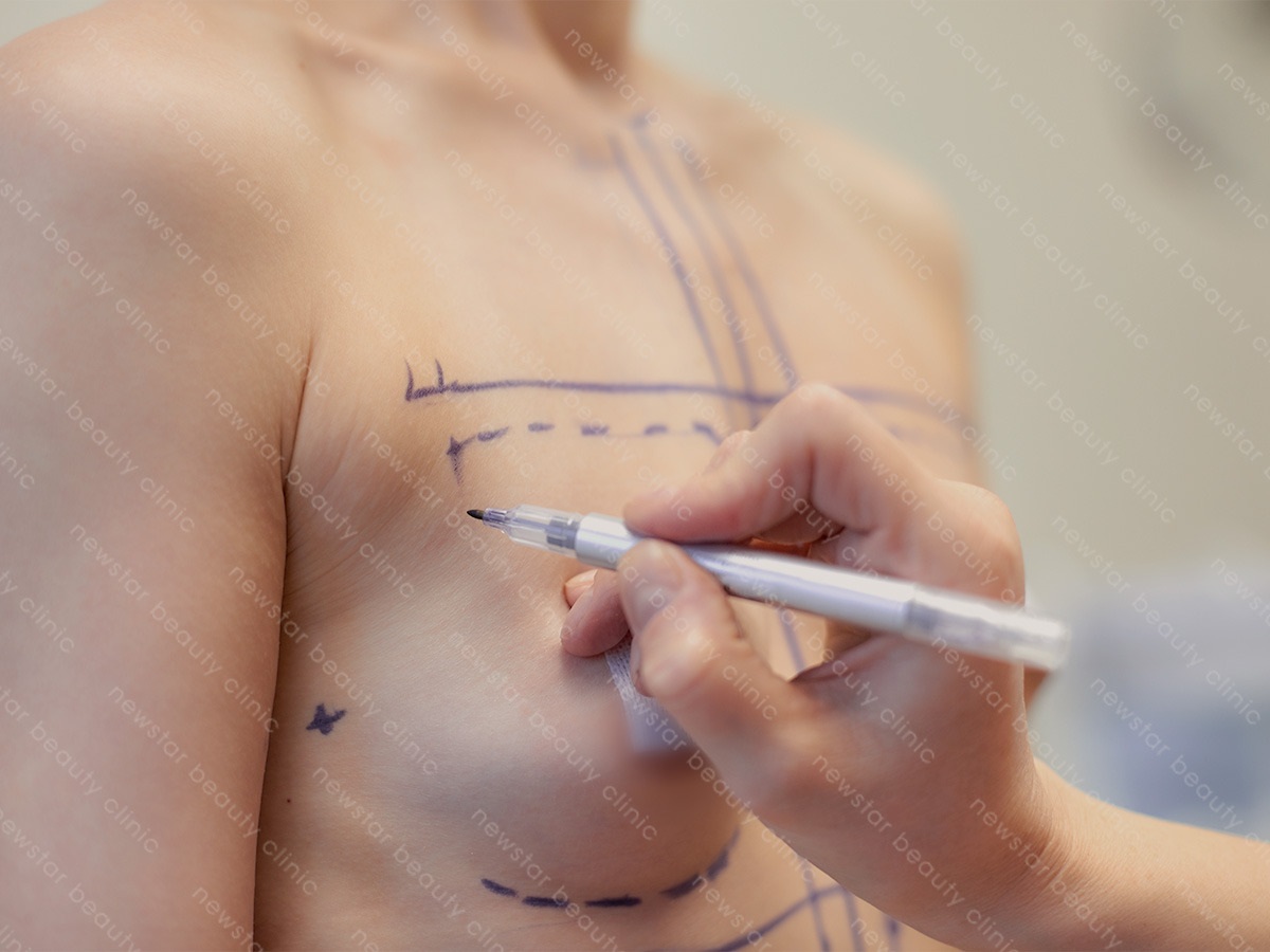 隆乳手術_手術流程_術前畫線定位
