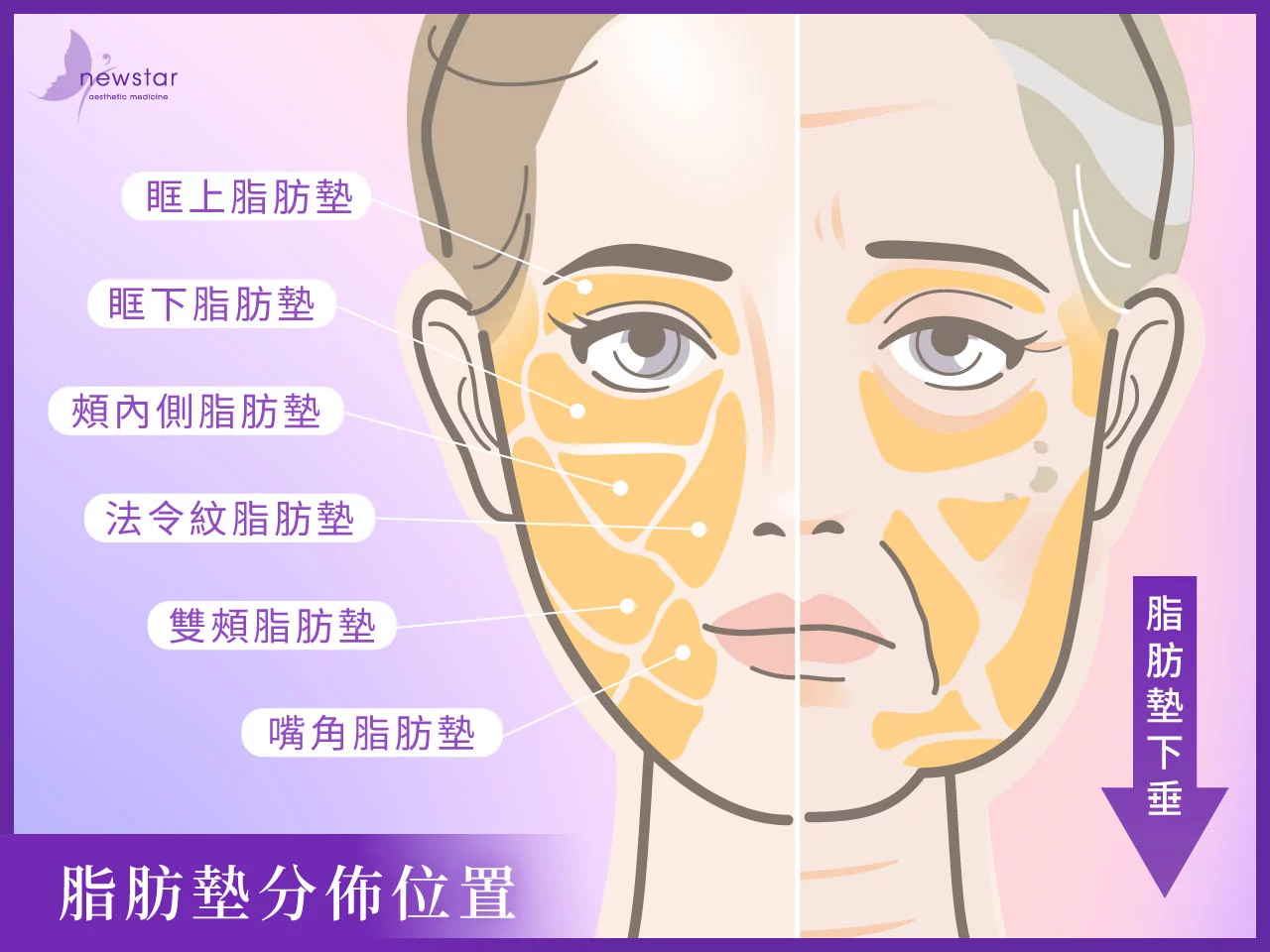 埋線拉提_拉提效果不明顯