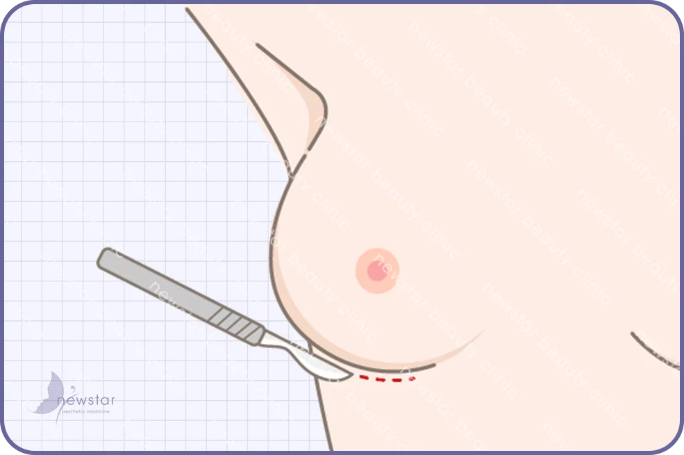 乳下緣切口03